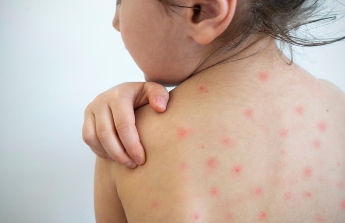 Após caso de sarampo em Rio Grande, SES alerta para importância da vacinação