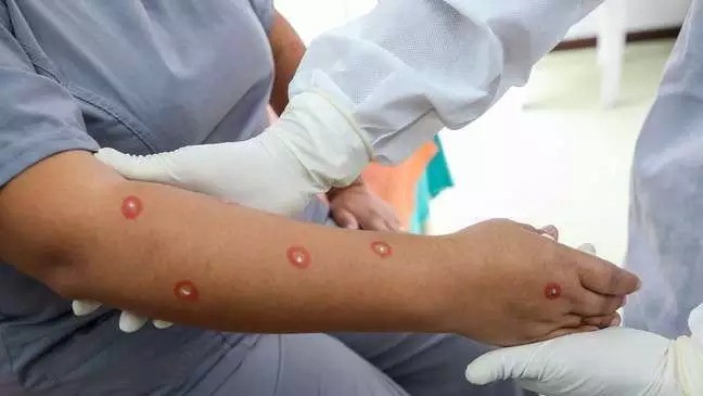 Governo negocia compra de 25 mil doses de vacina contra mpox
