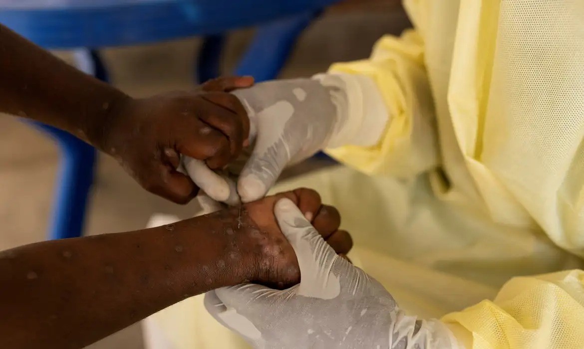 Brasil registra 1,5 mil casos de mpox em 2024
