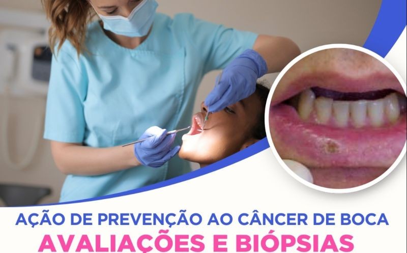 São José do Norte promove ação de prevenção e diagnóstico precoce do câncer de boca
