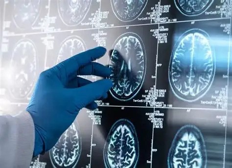 UFPel lidera etapa de pesquisa para diagnóstico de Alzheimer