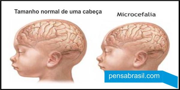 Crianças pobres com microcefalia têm direito a auxílio do governo