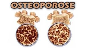 Osteoporose atinge 10 milhões de pessoas no Brasil