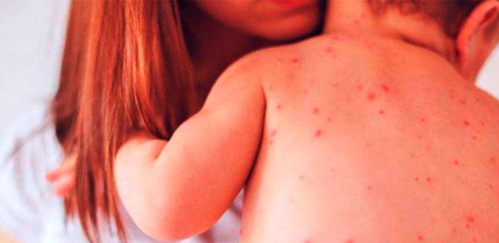 Vacinas contra o Sarampo já estão disponíveis