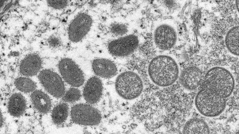 Rio Grande do Sul tem segundo caso suspeito de varíola (Monkeypox)