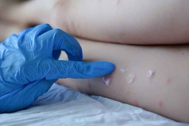 CIEVS Rio Grande alerta população sobre a varíola dos macacos