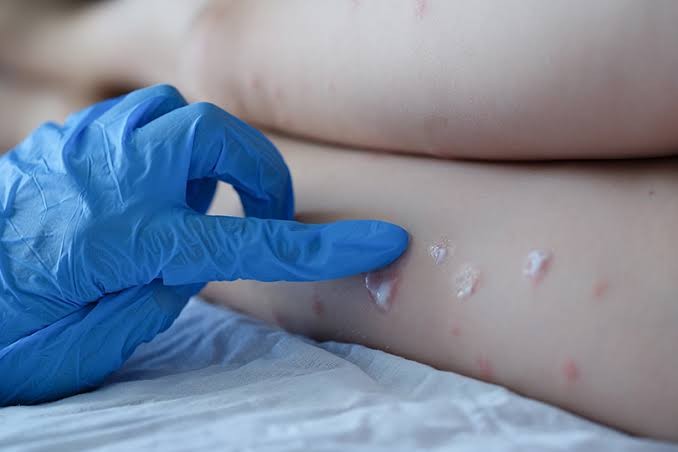 Secretaria da Saúde confirma mais um caso de monkeypox no RS